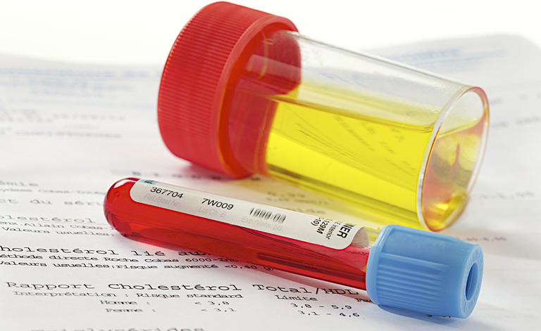 infezioni urinarie: le cause