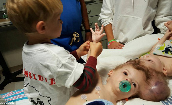 gemelli siamesi separati