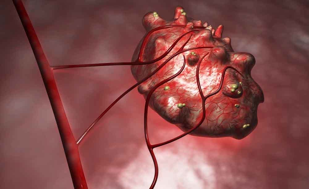 Cisti ovarica e tumore dell'ovaio