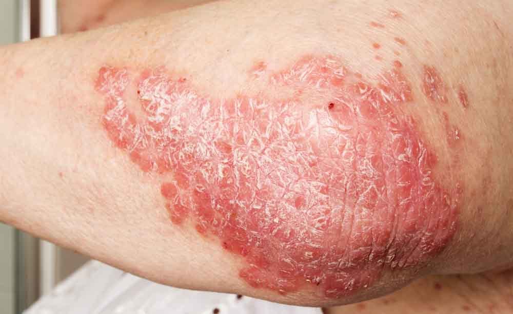psoriasi: malattia della pelle