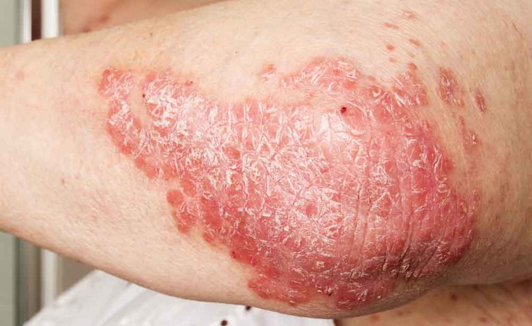 psoriasi: malattia della pelle
