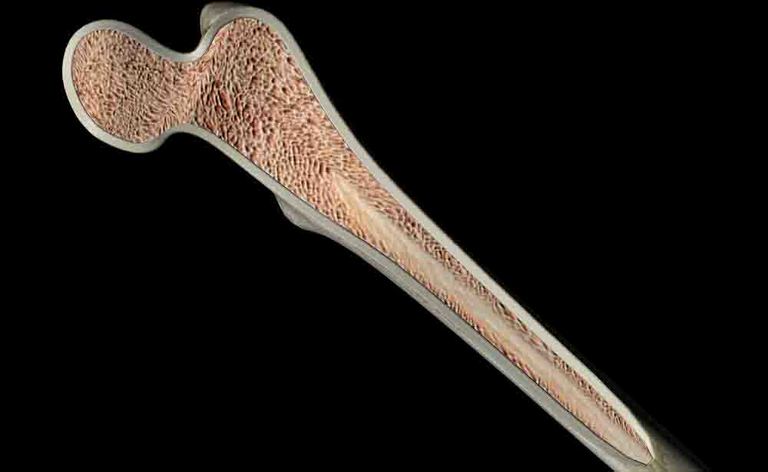 Impianti sintetici per le ossa