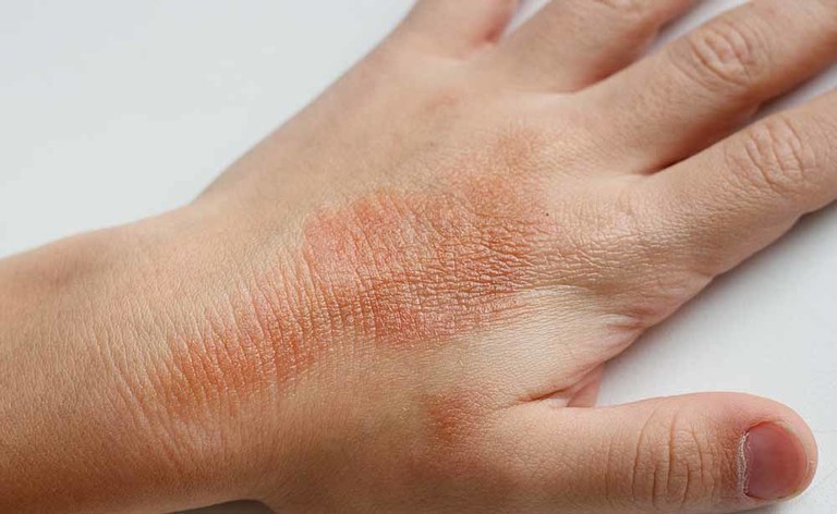 eczema: come si cura