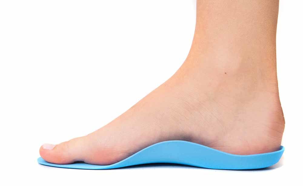 Piede piatto: come trattarlo