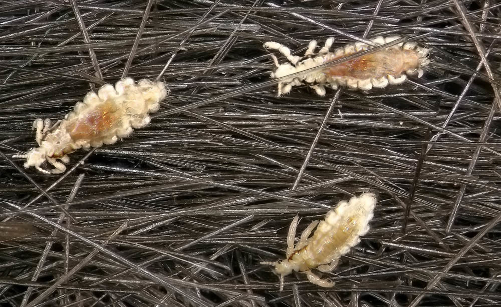 Pidocchi: come eliminarli