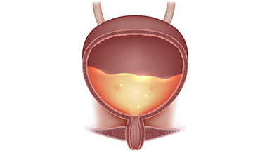 Cistite: come trattarla