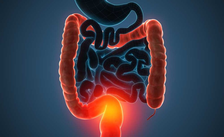 Morbo di Crohn: lo studio