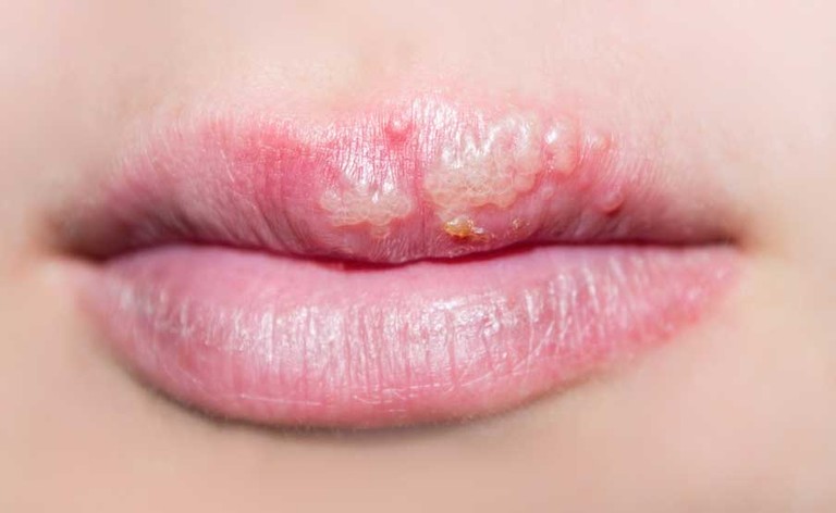 Herpes: la verità sulla malattia