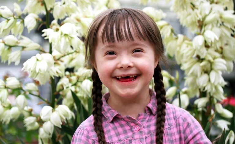 Sindrome di Down: vita media durata