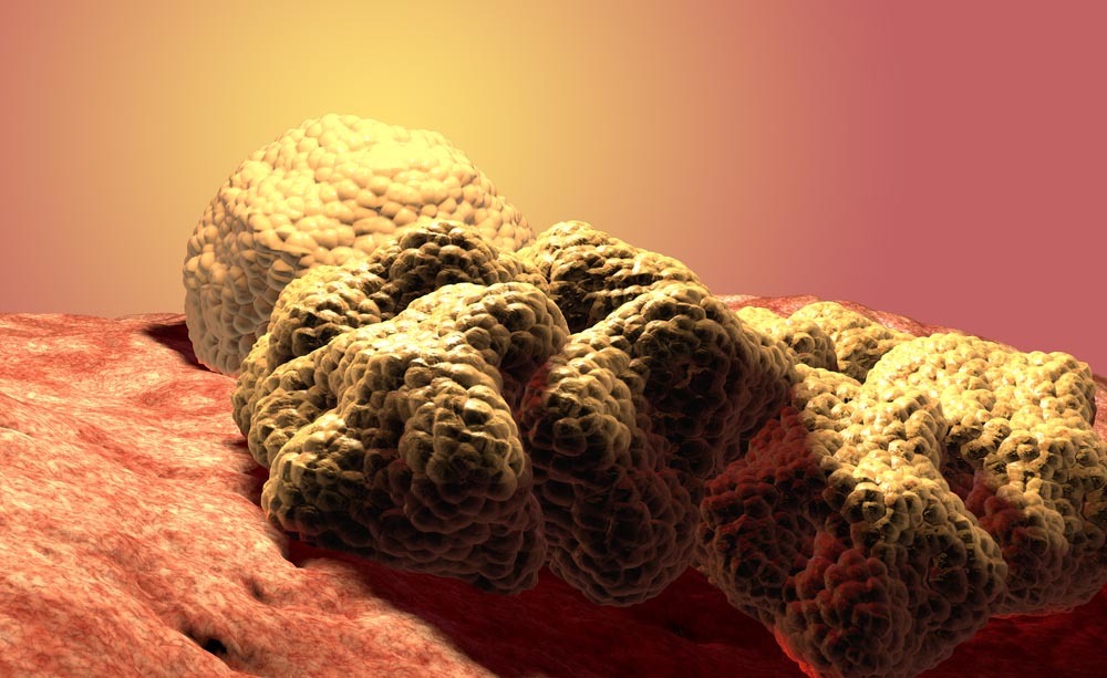 Tumore al seno: i test genetici