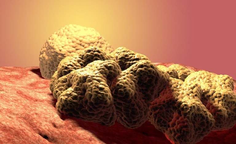 Tumore al seno: i test genetici