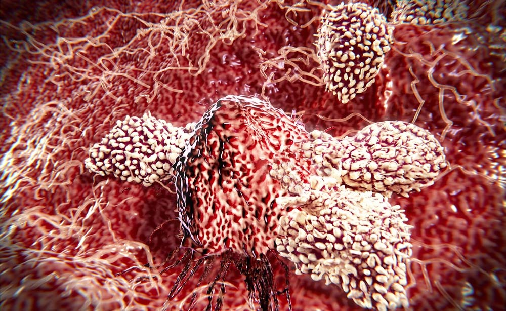Scoperto modo per bloccare le cellule tumorali