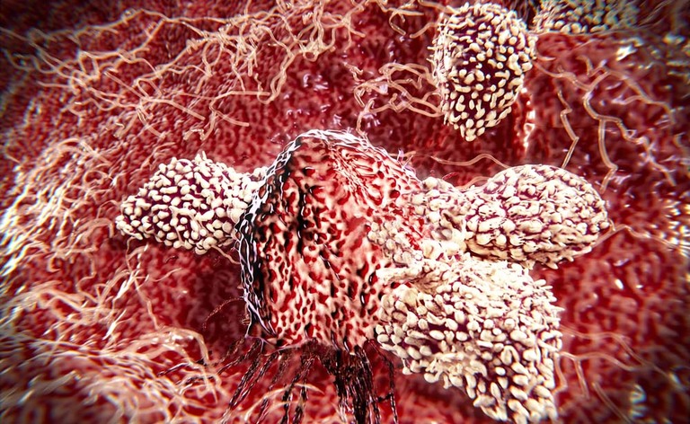 Scoperto modo per bloccare le cellule tumorali