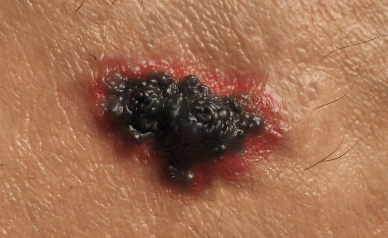 Melanoma: screening