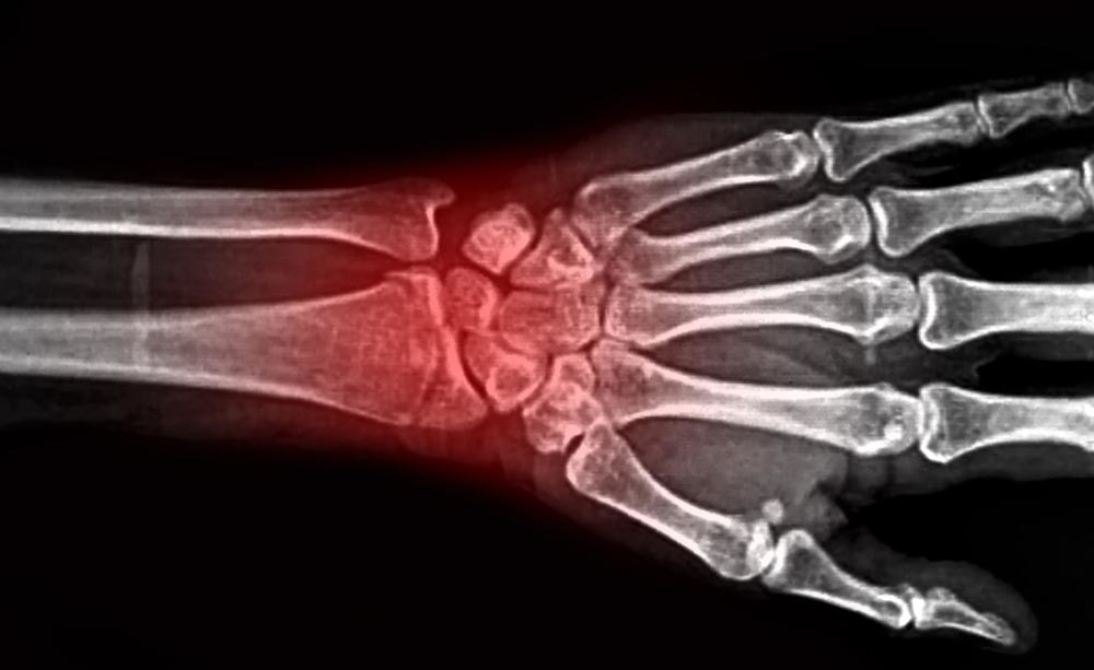 Rottura del polso e fisioterapia