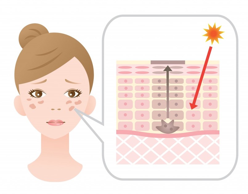 Macchie solari del viso