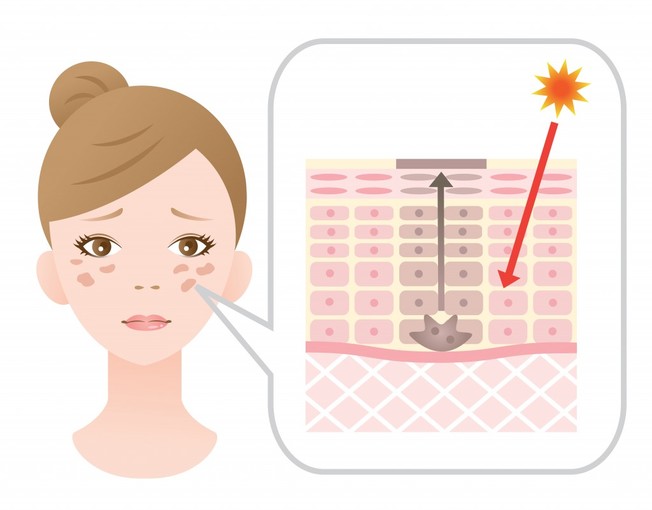 Macchie solari del viso