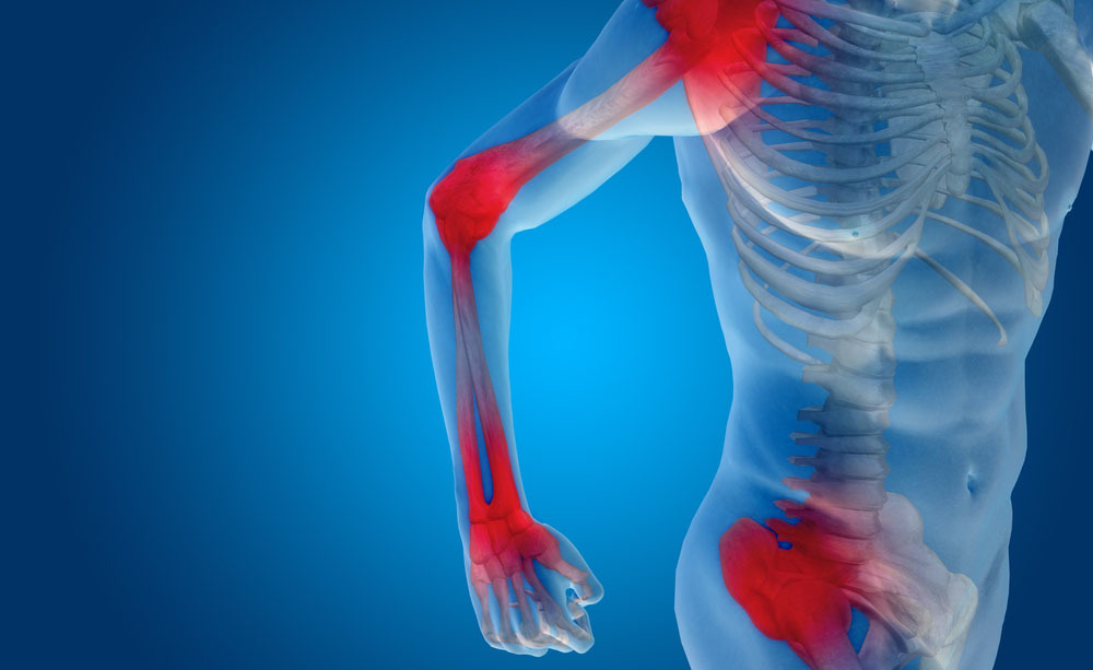 Artrite reumatoide: cause e sintomi