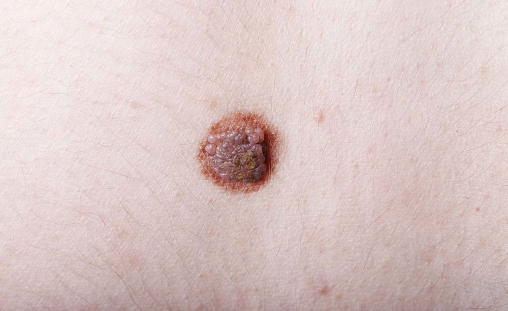 Disturbi della pelle