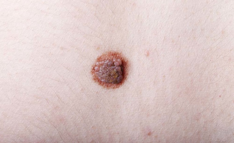 Disturbi della pelle