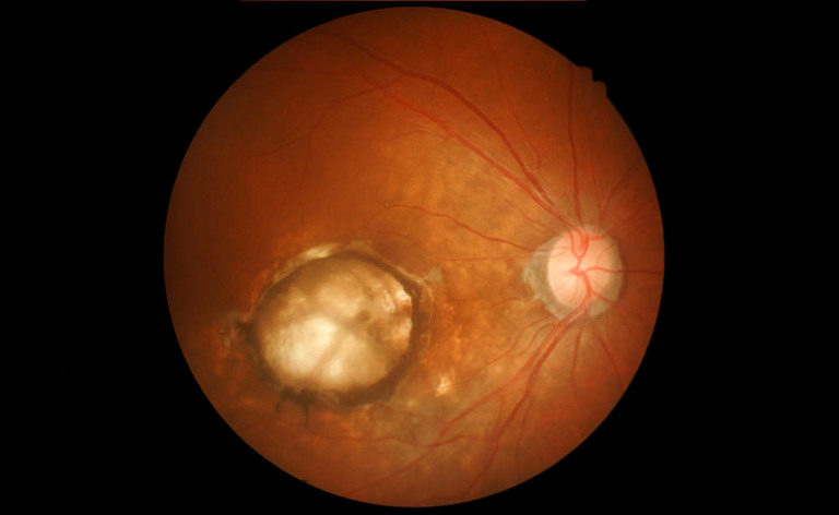 Degenerazione maculare età