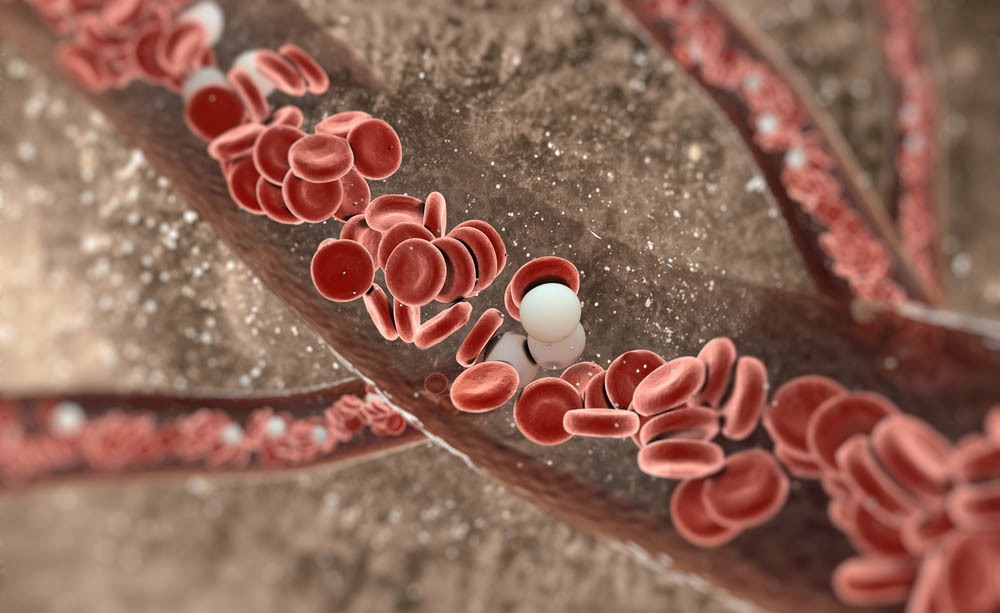 Insufficienza venosa