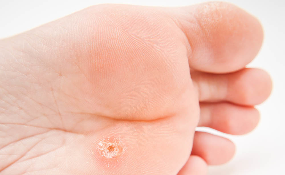 Verruche e micosi ai piedi