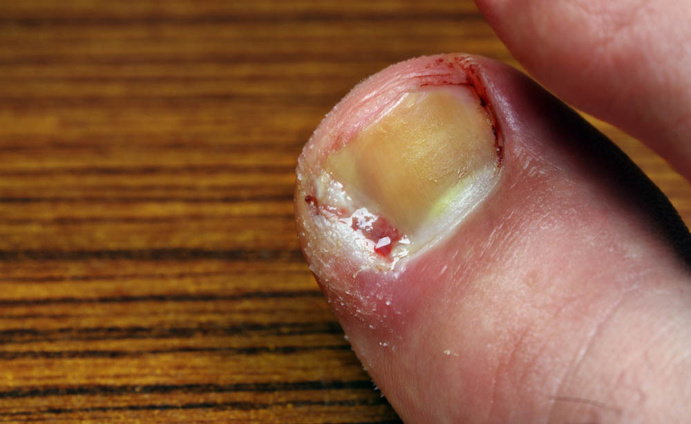 Unghia incarnita: i rimedi naturali