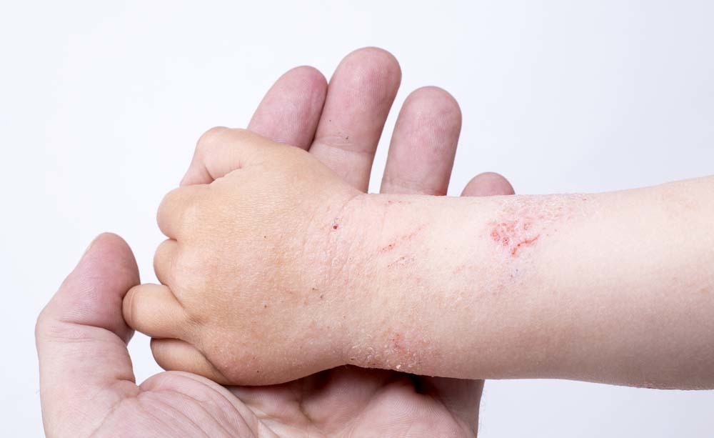 Eczema infantile: come prevenirlo