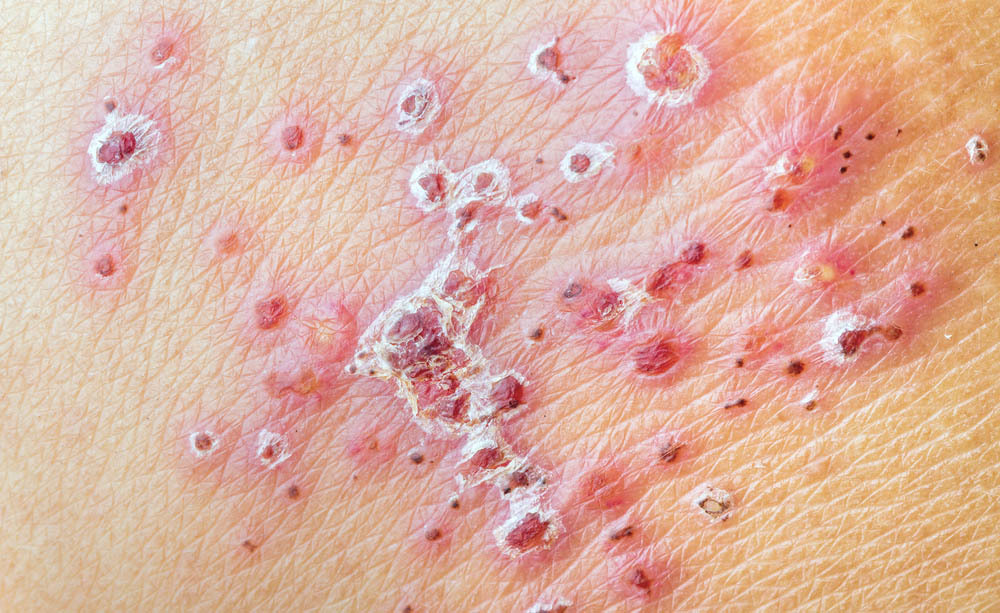 Herpes: effetti sul colon