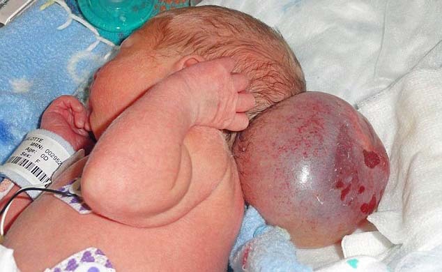 Un encefalocele rimosso con successo