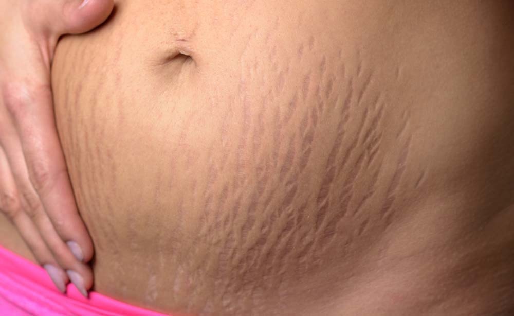 Come eliminare le smagliature