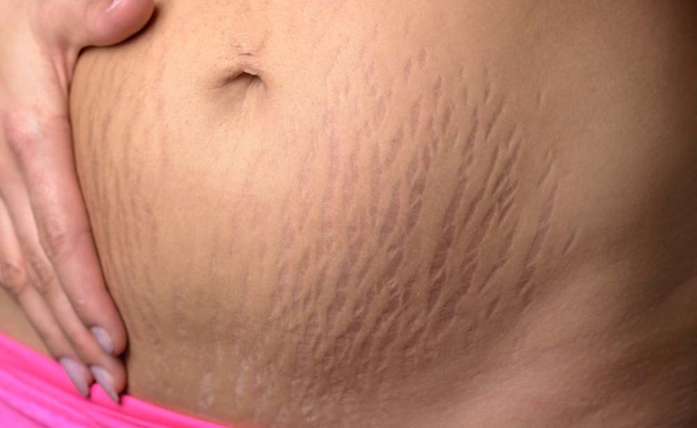 Come eliminare le smagliature