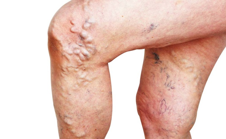 Le vene varicose.