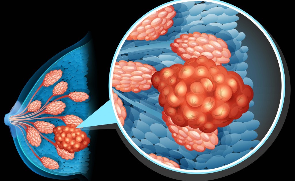 Tumore al seno: la diagnosi