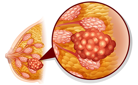 Tumore al seno: come eseguire l'autopalpazione