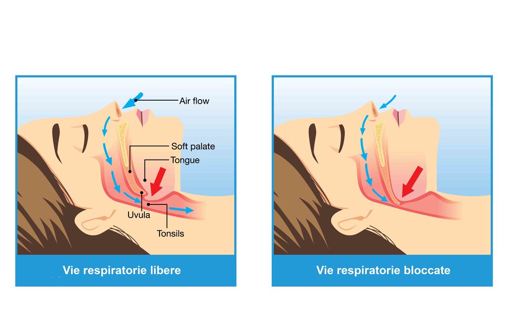 Apnee notturne bloccano il respiro