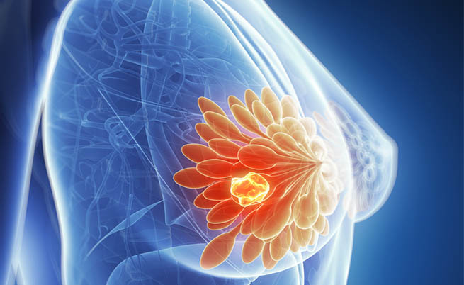 tumore al seno tumore al seno: i fattori di rischio