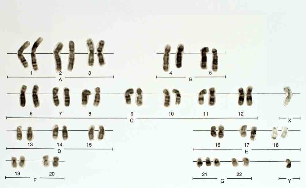 Le cause delle anomalie cromosomiche