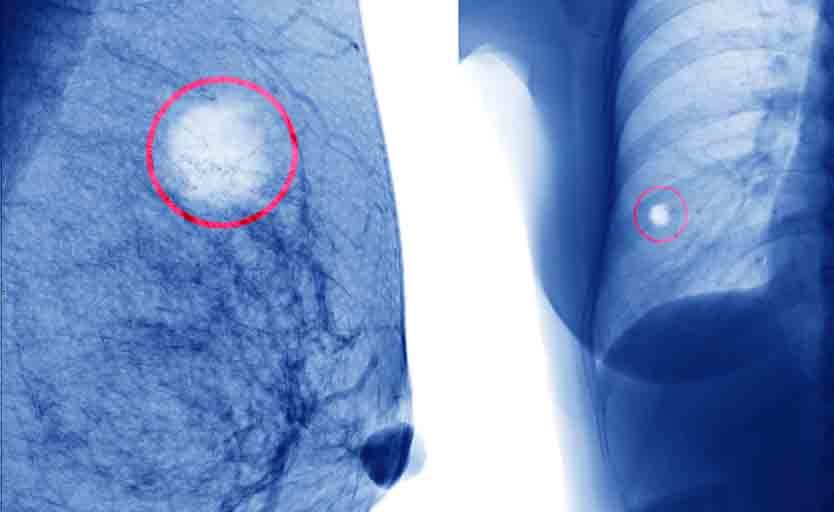 Cancro al seno: la diagnosi del tumore