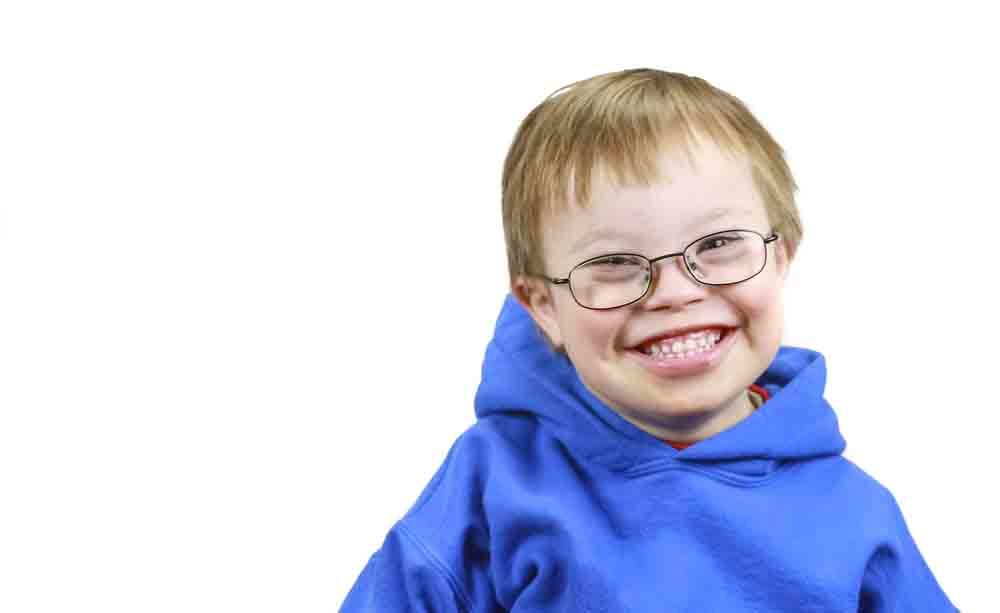 Sindrome di Down: caratteristiche