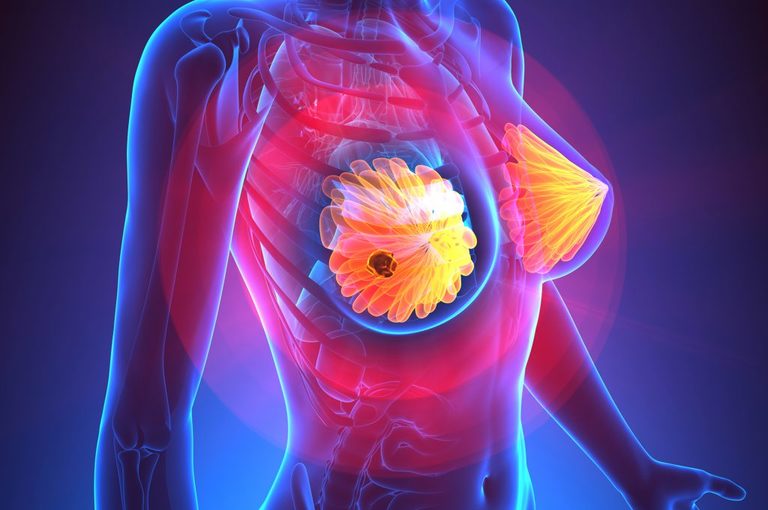 Reggiseno e Tumore al seno