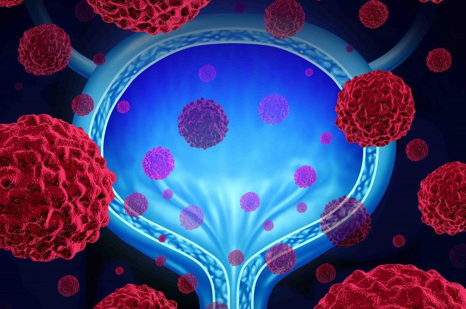 Tumore alla vescica e acqua potabile: uno studio rivela il legame