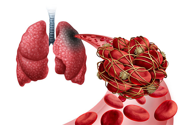 Coronavirus e trombosi: il legame
