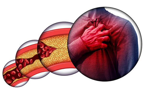Perché aumentano i morti per infarto: le indagini del Centro Cardiologico Monzino