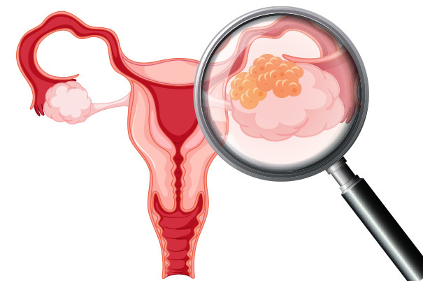 I sintomi del tumore alle ovaie