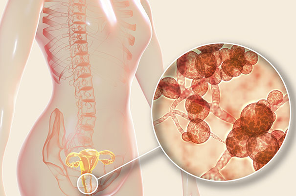 Alimentazione per la candida: quale dieta seguire?