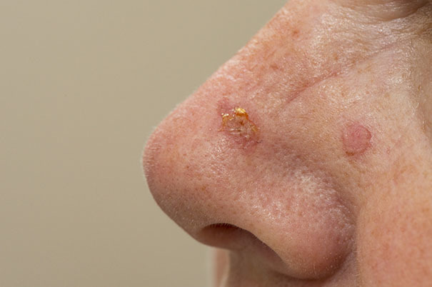 Cheratosi attinica: cure