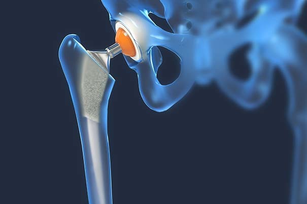 Intervento di protesi all'anca: come funziona, rischi, riabilitazione