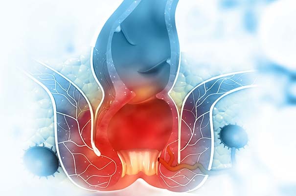 Cosa fare per le emorroidi sanguinanti